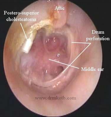 - What are the complications of otitis
