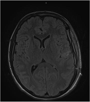 Electrocorticography (ECoG) Multiregional (frontal opercular, inferior parietal, and mesial temporal) onset with evidence of interictal discharges spanning the temporal lobe.