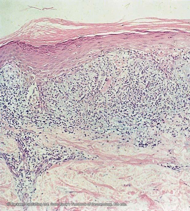 Chapter 1: Introduction to lichen planus Inflammatory infiltrate extends up to and in some areas effaces the epidermis Dense inflammatory cell infiltrate in the upper dermis Figure 4: Low power