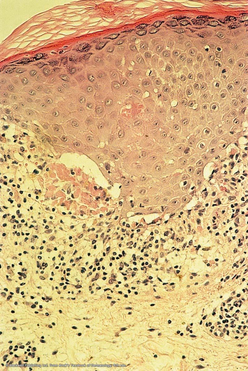 Chapter 1: Introduction to lichen planus Thickening of granular cell layer Inflammatory infiltrate effaces and causes degeneration of basal cell layer Band-like inflammatory infiltrate in upper