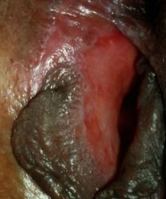 Lacrimal duct Oral
