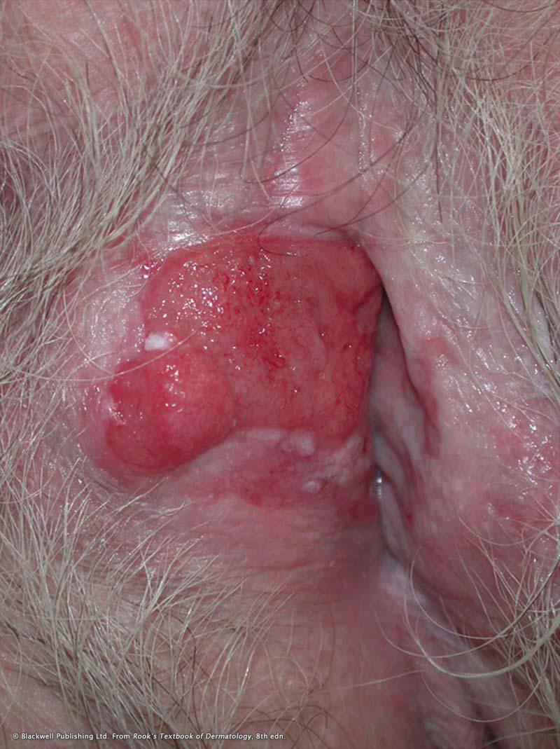 Chapter 1: Introduction to lichen planus Figure 10: Squamous cell carcinoma on the right labia minora The malignancy has developed secondary to pre-existing lichen sclerosus.
