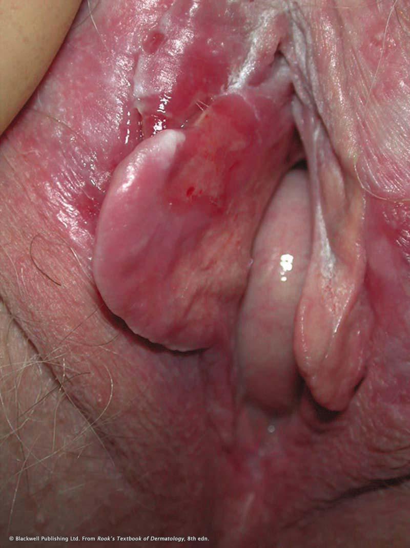 Chapter 1: Introduction to lichen planus Figure 12: Mucous membrane pemphigoid affecting the vulva.