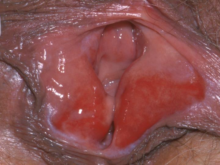 Chapter 1: Introduction to lichen planus Figure 14: Well demarcated vaginal introital erosions