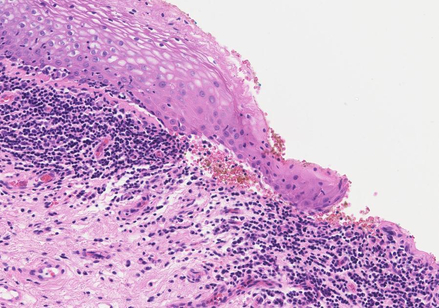 The epidermis is missing on the right hand side due to erosion. Courtesy of Dr S. Deen Figure 17: High power histopathological image from erosive lichen planus affecting the vulva.