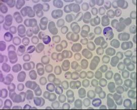 PCE E MNPCE NCE E Figure 2. Representative of cell appearace on pheripheral blood under treatment.