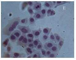 treatment with chloroform extract of P. glauca leaves for 15 hours. B. untreatment cells; The arrow indicate prb expression Allert score Grade of prb expression in HeLa cell 5 4 4.2 3 2 1 1.
