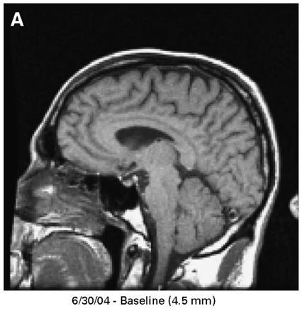 Endocrinopathies and Hypophysitis Can present with severe HA Differential of HA
