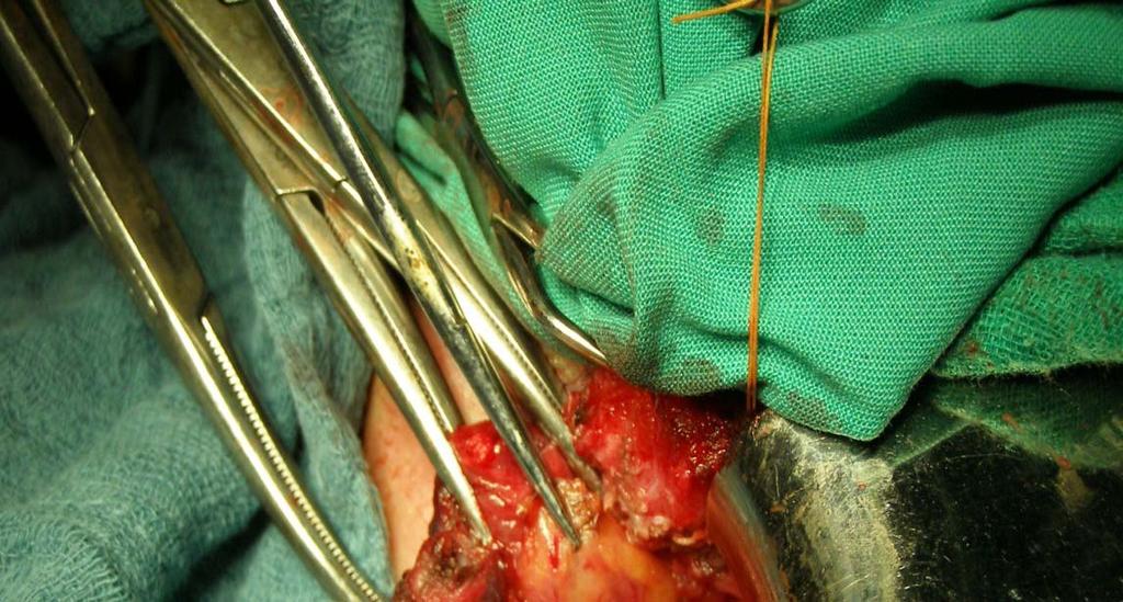 Reoperative central neck surgery Surgical Technique-