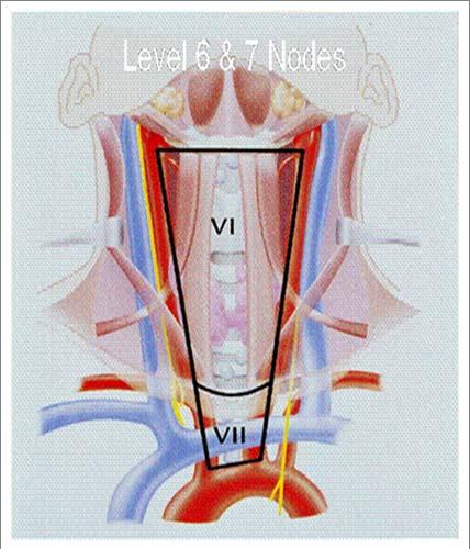 Central compartment lymph nodes are composed of: perithyroidal, pretracheal, paratracheal, prelaryngeal, delphian,