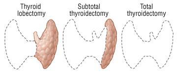Extent of surgery: controversy Total thyroidectomy: Eradication of possible bilateral disease Ability to use of radioactive iodine Easier detection of recurrence Lobectomy: Indolent disease with
