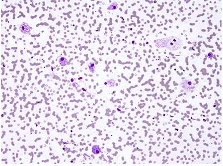 The Bethesda I (nondiagnostic/unsatisfact ory) Fewer than 6 groups of well-preserved, wellstained follicular cells;