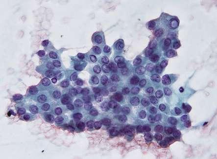 The Bethesda VI (malignant) 1. Papillary Ca 2. Medullary Ca 3.