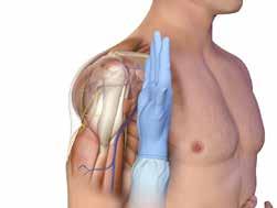 CG13 VERSION 1.1 6/16 3.12.3 Place your palm on the patient s shoulder anteriorly. You should be able to feel the target area under your palm, it feels like a ball.