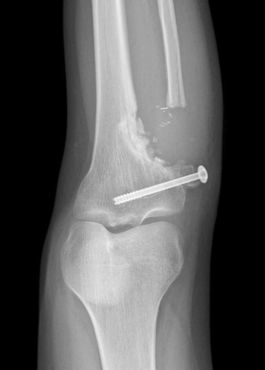 (A) Plain radiographs taken 3 years before the surgery showing a benign osteochondroma in the proximal tibia. (B) Plain radiographs showing destruction of the fibula.