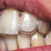 recess in the aligner, and they can have Activation,