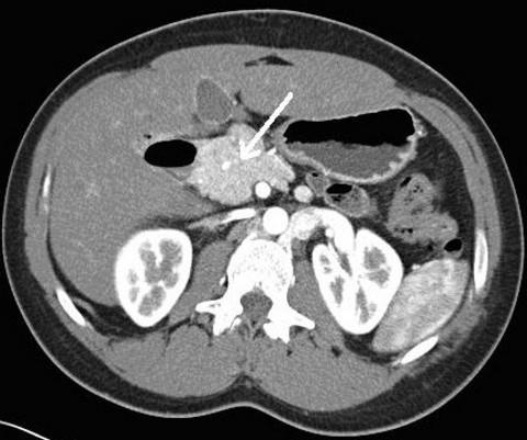 Figure 1. A prominent pancreatic head with associated absence of body and tail of the pancreas (arrow). The mild prominence of the pancreatic head may be due to some compensatory hypertrophy.