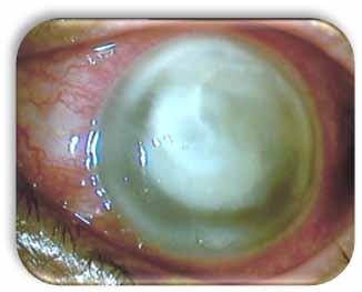 Fig.1: Corneal ulcer on