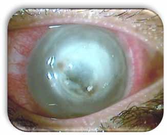 2: Perforated corneal