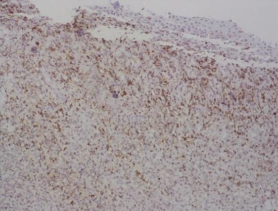IgG4 ( 40%). (e) Immunohistochemistry study for CD4 cells at high-power field.