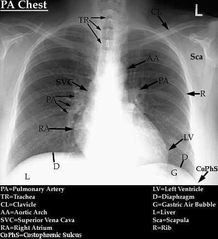 Rindkere otseülesvõte 1)PA-suunas ülesvõte: haige on näoga ekraani ehk siis filmi suunas (süda paikneb enam rindkere eesmises osas, seega on moonutused südame mõõtmete kohta siis kõige väiksemad).