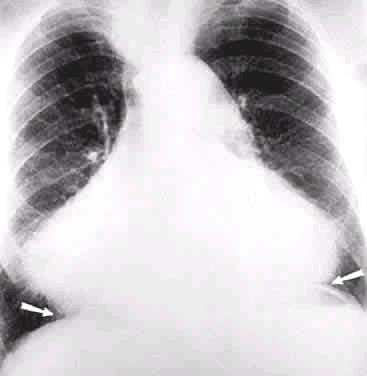 Cor pulmonale (promineerub pulmonaalkaar) Hüpertooniatõbi.Algstaadiumis esineb mõõdukas vasaku vatsakese hüpertroofia, suureneb pulsatsiooni amplituud aordil ilma diameetri suurenemiseta.