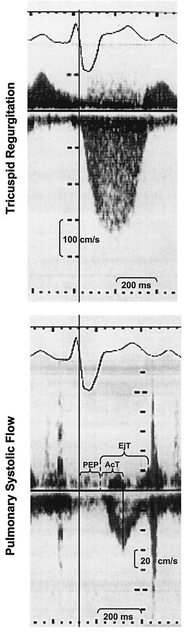 JACC Vol. 37, No. 7, 2001 June 1, 2001:1813 9 Scapellato et al. Doppler Estimation of Pulmonary Vascular Resistance 1815 Table 1.