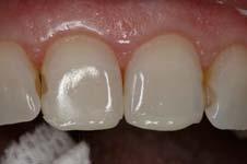 If areas of dentin, 15 20 seconds etch only. 9. Rinse, leave moistened. 10. Place multiple layers of 5 th generation of adhesive. Air thin. Light cure 20 seconds.
