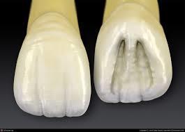 The permanent maxillary Incisors Maxillary incisor are four in number.