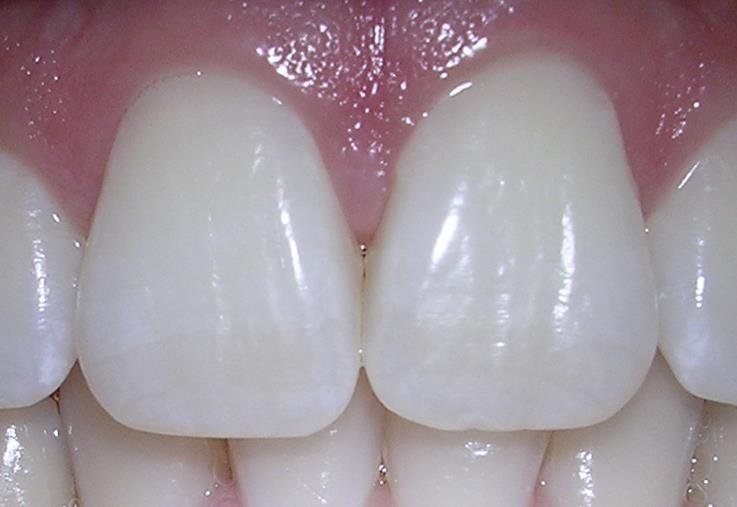 Interproximal contacts Contact with adjacent teeth in the same arch is referred to as interproximal contacts.