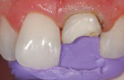 Introduction to Layering with Filtek Supreme Plus Universal Restorative TM Placement of Composite The lingual matrix was seated. A very thin increment (roughly.