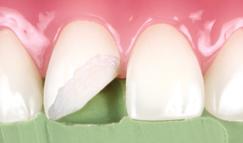 This bevel allows a natural transition from tooth to composite.