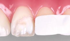 A dentin opacity is suggested, with a thickness of approximately 1/3 of the thickness of the tooth.