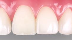 Esthetic suggestion: On a typical typodont tooth, we recommend Filtek Supreme Plus universal restorative WD.