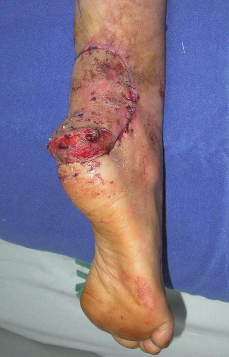 Vol. 40 / No. 3 / May 2013 Fig. 4. Ulcerating lesion on the heel Preoperative photograph showing Marjolin s ulcer on the right side heel. Fig. 5.