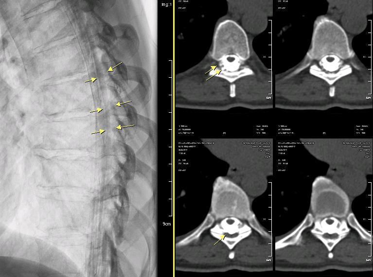 . Figure 4 5. What would be your treatment plan? Various techniques have been described for sealing spinal CSF-leaks, with epidural blood patches being the treatment of choice [5,6].