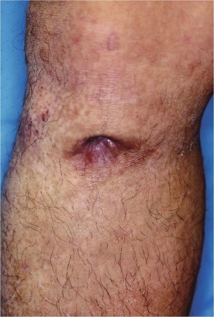 122 H. Numazaki et al. bridement with interference screw removal was performed, but wound infection was prolonged, and a fistula formed again.