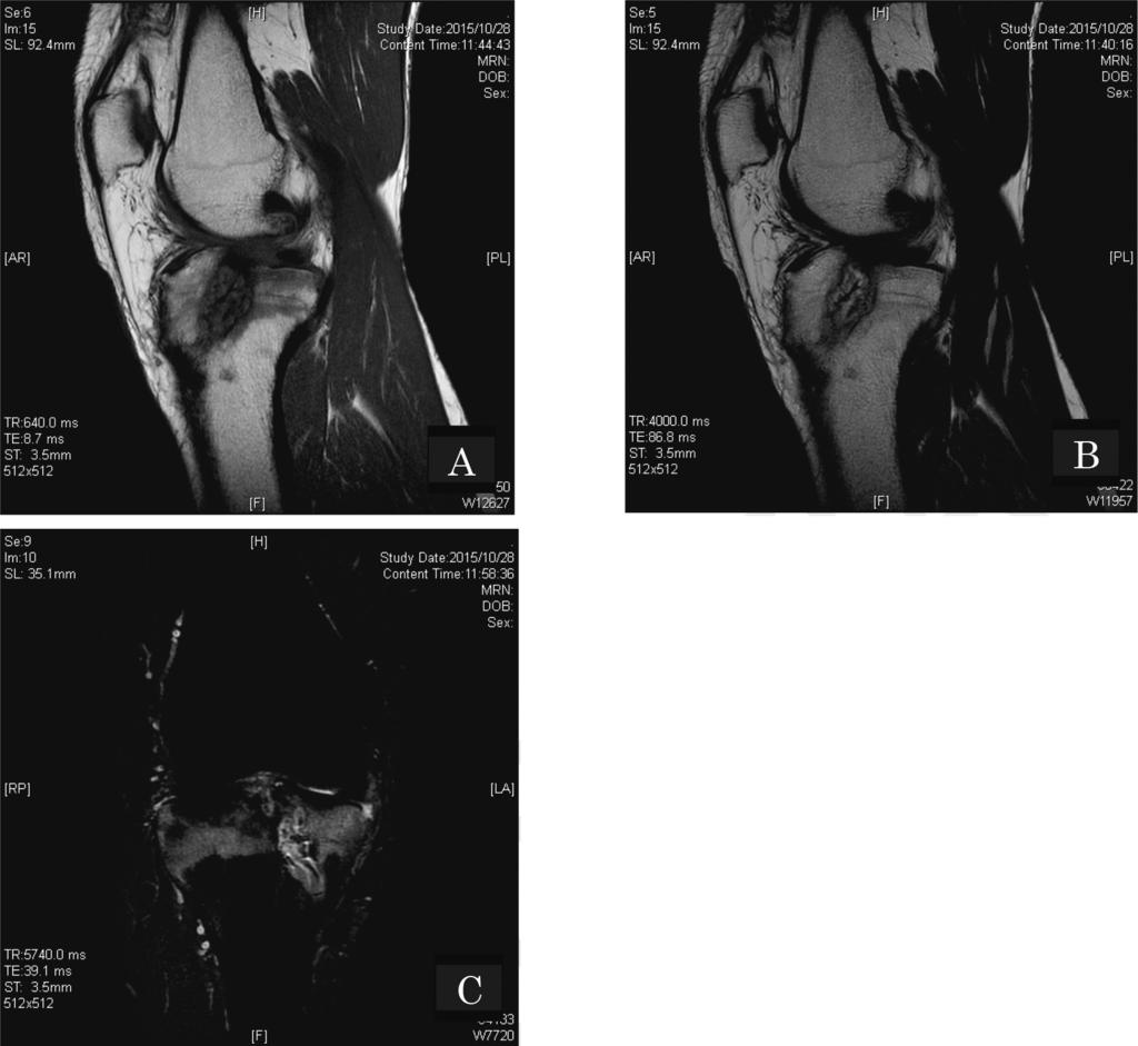 Prolonged infection after ACL Reconstruction 123 Fig. 3. MRI of the right knee.