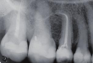 RECIPROC System Tooth: