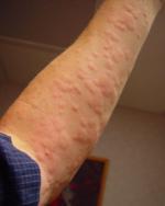 Urticaria, angioedema (swelling), redness Other: Anxiety, feeling of