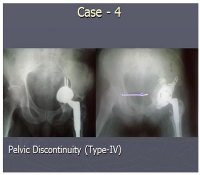 Table 2 Case 4 Case 1 COMPLICATONS: One patient had a dislocation within one month after revision and was treated with closed reduction and immobilization but