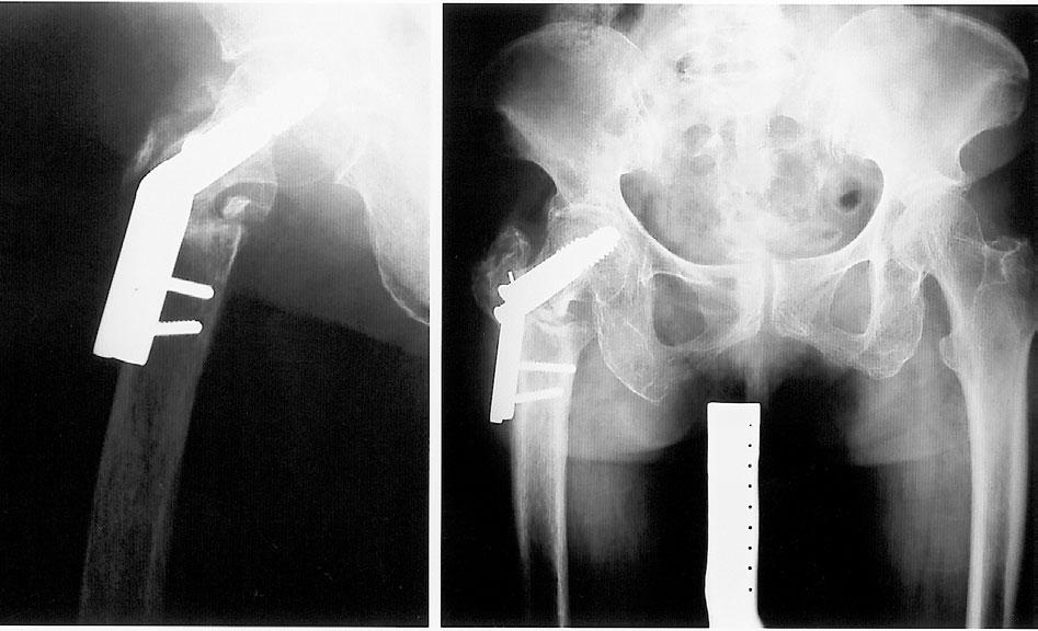 269 Lin-Hsiu Weng and Jun-Wen Wang tional osteosynthesis combined with cortical strut allografts and autogenous bone grafts for nonunions of the femur including intertrochanteric, diaphyseal, and