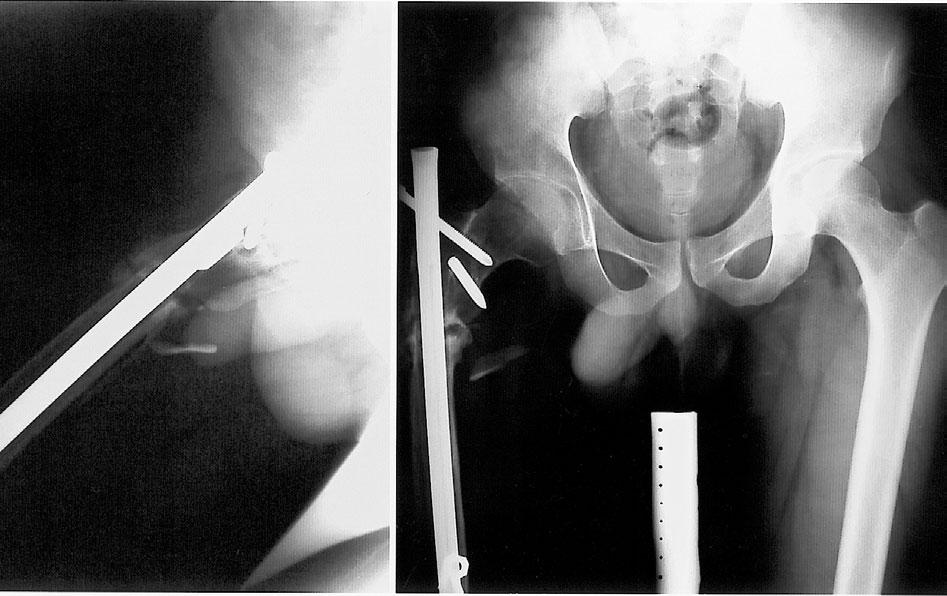 271 Lin-Hsiu Weng and Jun-Wen Wang A B Fig. 2 (A), (B) A 25-year-old man (case 3) with nonunion of the subtrochanteric fracture of the right femur after 2 attempts at intramedullary nail fixation.