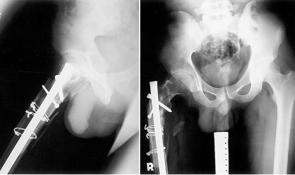 (B) Anteroposterior radiography of the pelvis and lateral radiography of the right hip taken 8 months after open reduction internal fixation with a locked nail, bicortical strut allografts, and