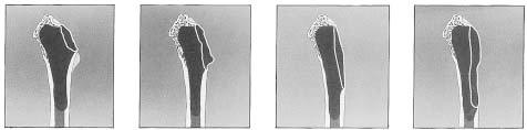 Moderate - Standard or long stem, D or F cone with large triangle. Severe - Standard or long stem, F cone or upsize cone by use of mm diameter increasing sleeve.