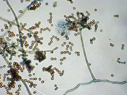 94 Descriptions of Medical Fungi Morphologically the genus Fonsecaea is defined by the presence of indistinct melanised conidiophores with blunt, scattered denticles bearing conidia singly or in
