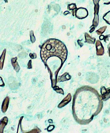 conical-shaped columella and pronounced apophysis (arrow), and (c) Grocott s methenamine silver