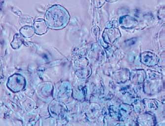 196 Descriptions of Medical Fungi Trichophyton concentricum is an anthropophilic fungus which causes chronic widespread non-inflammatory tinea corporis known as tinea imbricata because of the