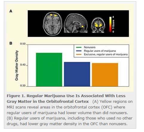 Regular Marijuana Use Is Associated With Differences in Brain Gray Matter and Connectivity Filbey, F.M.; Aslan, S.; Calhoun, V.D.; et al.