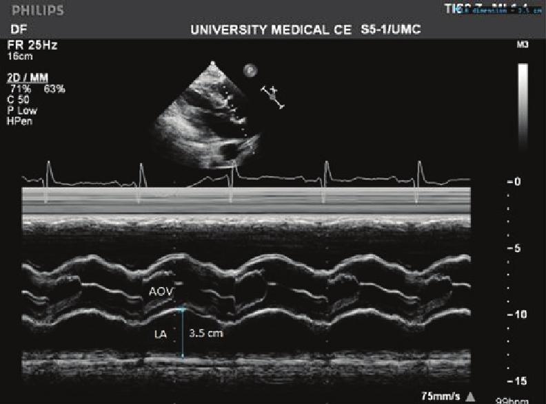 Left Atrial Function Figure 1-A. LA size measured by 2-D guided M-Mode echocardiography in parasternal long axis view LA size is measured at its maximum diameter at end systole. In this case it is 3.
